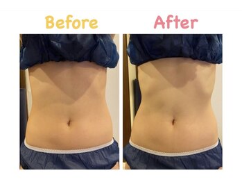 クレビア 麻布十番(CREBIA)/【痩身/代謝促進】