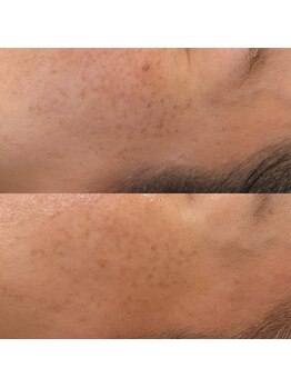 エン(enn)/【シミ改善】