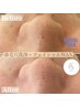 【気になる毛穴撃退でツルピカ】毛穴レス鼻洗浄＋マリムーブ顔WAX 脱毛¥9,900