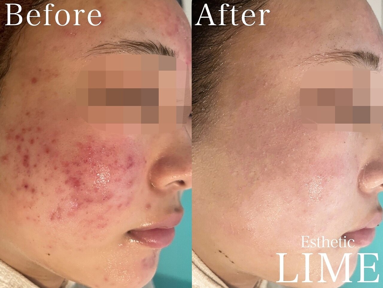 LMハーブピーリング/剥離あり☆完全個室で施術