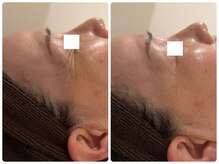 ビーグレイス(Vigrace)/ララピール/お肌のくすみに◎