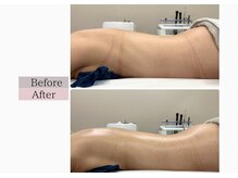 フロリール アザブジュウバン(FlorirAzabujuban)/ブライダル/痩身/背中痩せ