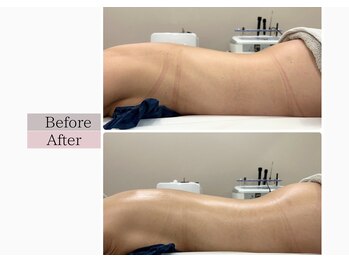 フロリール アザブジュウバン(FlorirAzabujuban)/ブライダル/痩身/背中痩せ