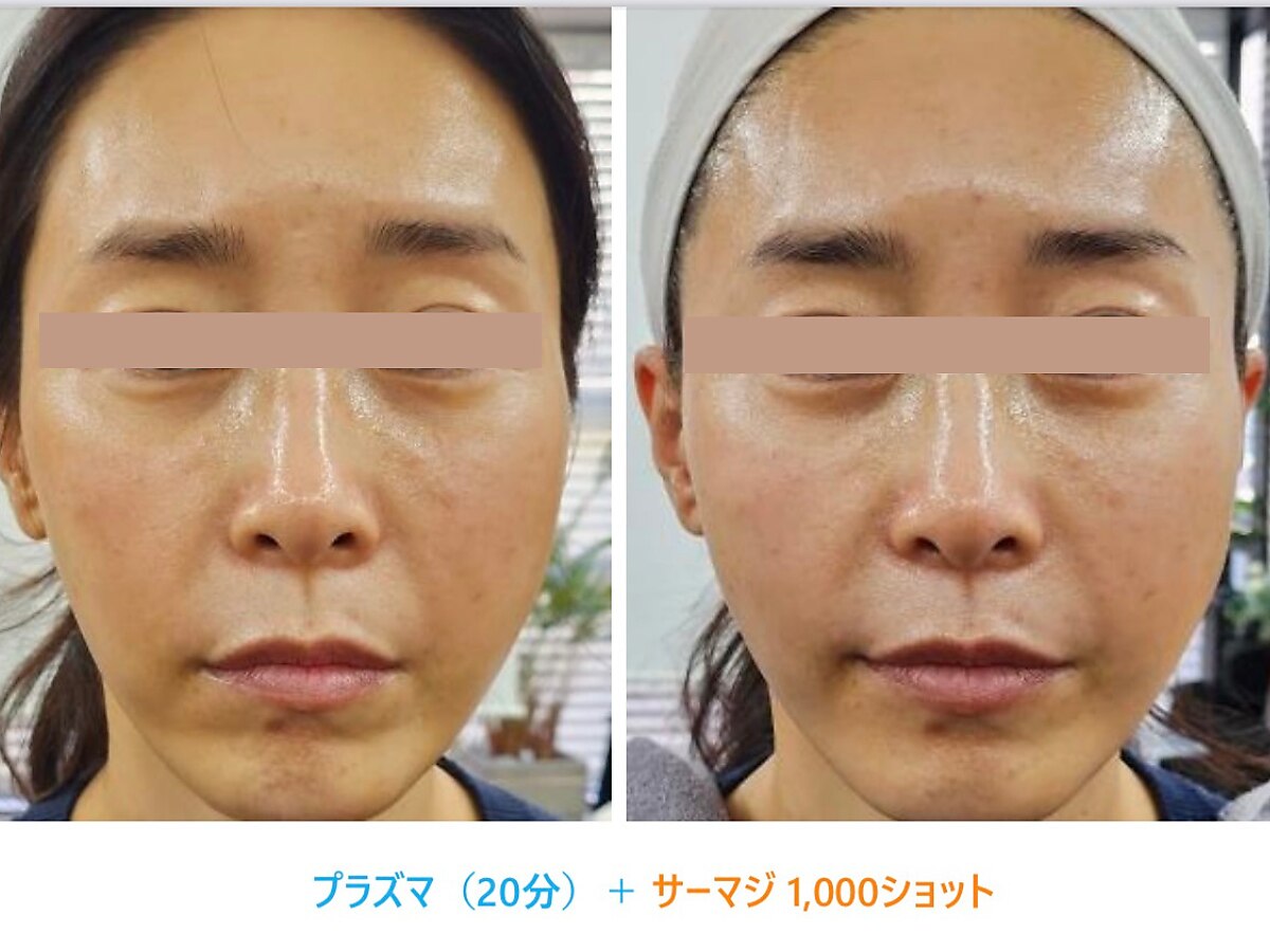 12月31日まで【大特価年末セール】剥離ありハーブピーリング20回分 大特価年末セール】剥離ありハーブピーリング20回分 12月31日