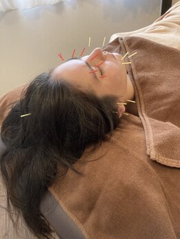 たから鍼灸院の写真/【即効リフトアップ】頭蓋骨小顔矯正×美容鍼のSETメニュ-◎年齢に負けない肌&理想のフェイスライン実現◇
