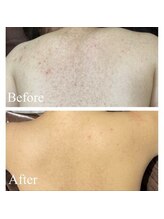 エミルカ 鹿児島店(EMILUCA)/ハーブピーリング