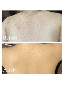 エミルカ 鹿児島店(EMILUCA)/ハーブピーリング