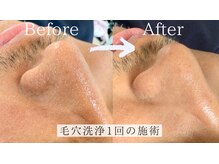 ナチュラル グロウ 木更津(NATURAL GLOW)/毛穴洗浄