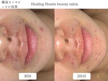 ヒーリングハーツ(Healing Hearts)/繰返す大人ニキビ改善スタート！
