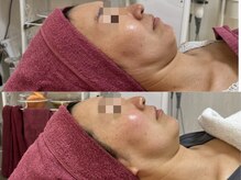 GRACETHOUSAND(グレイスサウザンド)/ハーブピーリング/毛穴洗浄