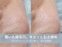 ラシック 加古川店(La chic.)/頬の毛穴・くすみを集中ケア