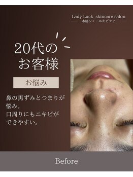 レディラック 大阪梅田本店(Lady Luck)/毛穴エクストラションコース
