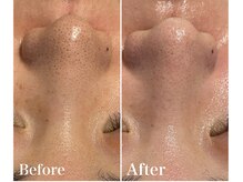 リブ(Lib)/ハーブピーリング♪