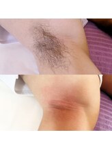 サロン ド モア(salon de MORE)/脇のダブル脱毛《男性》