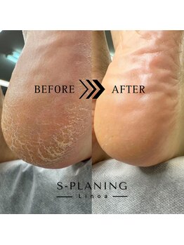 リノア(Linoa)/韓国式足裏角質ケア-splaning-