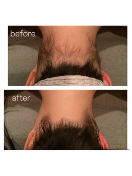 ゲッカ(GEKKA)/うなじ襟足脱毛