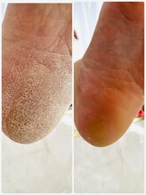 リラキュート(Rela Cute)/角質除去