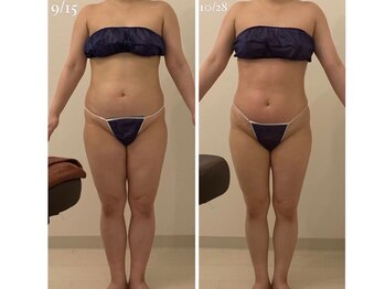 ラヴィエ ベル(La vie est belle)/セルライトゼロ2