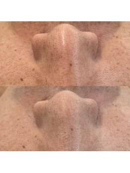 ヴェルシック(Belchic)/毛穴の汚れも一緒に吸着