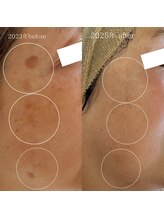 プライベートアイラッシュサロン ヴィレージュ 稲毛店(Vireijou)/大人気のシミケアで悩み解決！