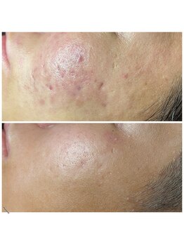 ソワラ(Soiela)/肌質改善