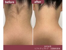 ウェルネス ステーション リンク(Wellness Station Link)/うなじ脱毛