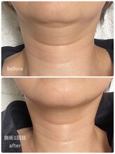 アキ/1回の施術効果！首までほっそり