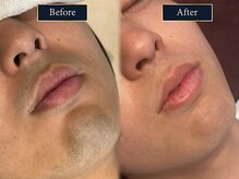 グラスト(Grast)/ヒゲ脱毛｜福岡/大橋/天神/博多