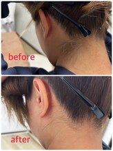 セブンスコード(7th CODE)/うなじ脱毛　　Before→After