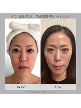 リュクシー(LuxeY)/韓国インセルダム7日間使用
