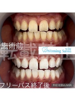 ホワイトニングサロン 名古屋 栄店/【ホワイトニング】