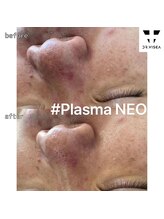 ルミラポー(Lumira Peau)/40代1回（炭酸パックも）