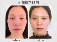 ビトリア 横浜店(BITORIA)の雰囲気（頬出っ張り、ほうれい線、むくみ、フェイスラインなど改善）