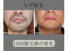 グロワール(gloire)/ヒゲ脱毛BeforeAfter