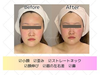 アンジェリカ(Angelica)/顔の歪み、エラ、眉の左右差