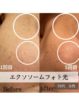 パルティノ 高崎店/5回目症例・50代・くすみ・シワ