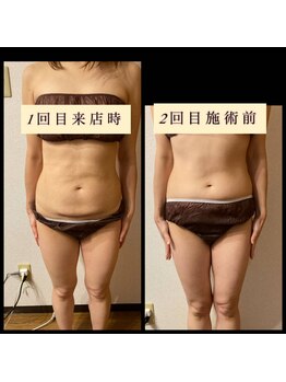 ティアメディカル(Tia Medical)/脂肪冷却1ヶ月後の変化