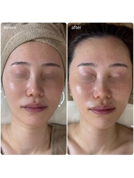 ルリエベル(Relier Belle)/最新肌育ピーリング★ラミピール