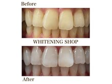 ホワイトニングショップ 湘 南辻堂店の雰囲気（回数券使用後のビフォーアフター）