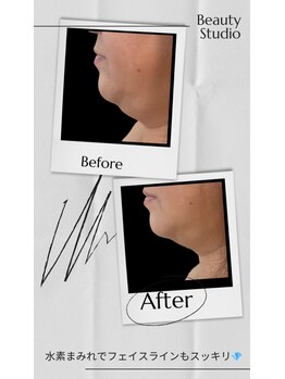 ヨサパーク ゴールデンツリー 浦安本店(YOSA PARK GordenTree)/フェイスラインスッキリ★