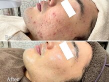 ニキビケア研究所 池袋店/メンズニキビケア