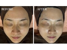 しみ、くすみ、はりをピーリングでトーンアップ