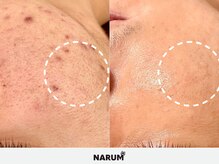 ナルムフェイシャル 代々木(NARUM facial)/メンズハーブピーリング