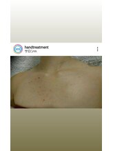 サロンエム(Salon m)/胸元ニキビケア