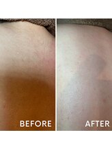 グリン(grin)/ワックス脱毛(4)