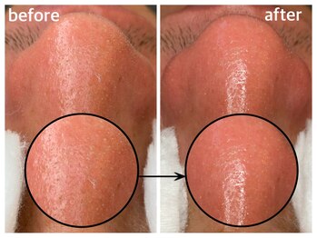 毛穴専科/ワックス脱毛メンズok/沖縄/那覇