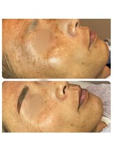 ディンプル(Dimple)/サーモンピーリングのお客様！