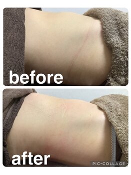 ギンザアール(GINZA R.)/ぽっこりお腹にアプローチ！