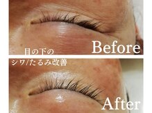 サロンドエステ ルヴニール(salon de esthe revenir)の雰囲気（目元の下のシワ改善でハリ艶UP♪）