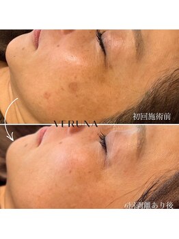 アトワ(A toi)/ハーブピーリング(棘あり)